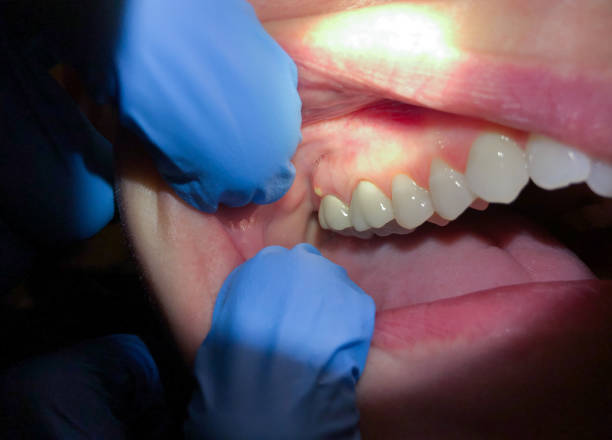 Best Emergency Dental Extractions in Evans, GA